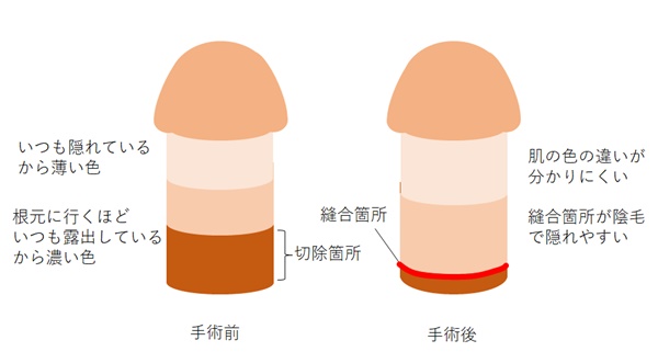 陰茎根部切開法